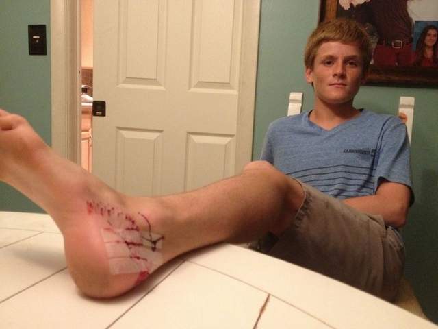 Kai Rittgers, 14, was surfing at North Spessard Holland Park when he says a 2- to 3-foot shark chomped down on his left foot. / COURTESY OF BRYCE RITTGER